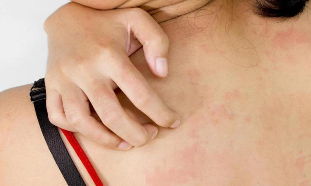 Σε τι διαφέρει η τροφική δηλητηρίαση από την τροφική αλλεργία;